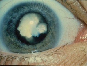 Nuclear Sclerotic - Courtesy National Eye Institute